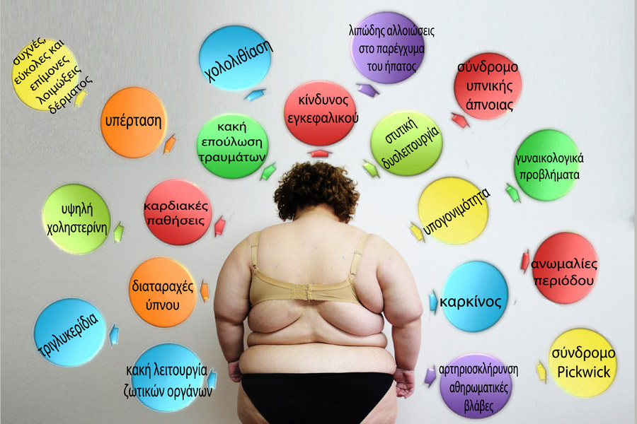 παχυσαρκία